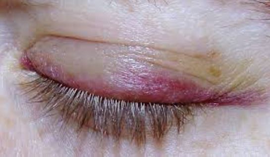 Rash and Swollen Eyelids - Treato