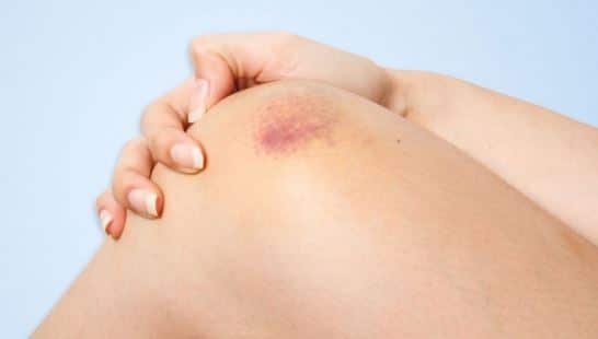What causes sores on the buttocks that are not bruises?