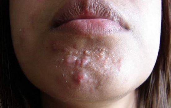 Bumps on Chin, Small White Red Hard ... - Treat, Cure Fast