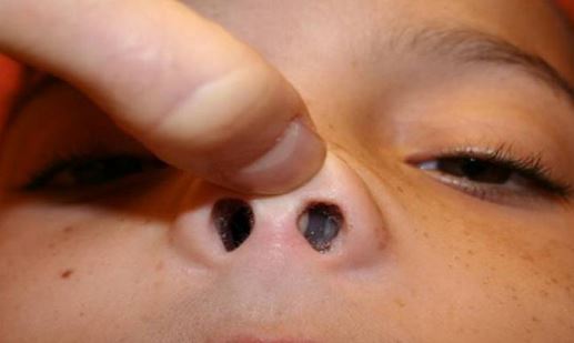 Bumps on Nose Causes, Small, Big, Painful, Hard, on Nose ...