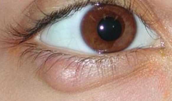 eyelid dermatitis #10