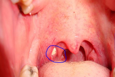 papilloma on tonsils