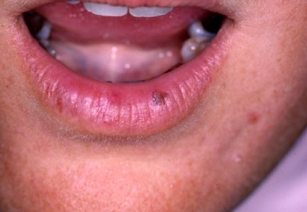 Dermatology Lips Doctor Answers, Q&A, Tips - RealSelf