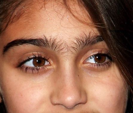 How to get rid of a unibrow permanently
