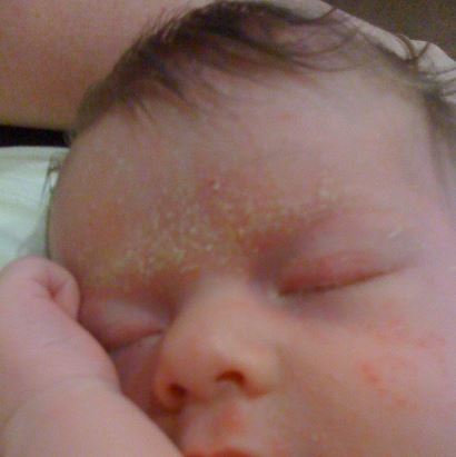 In some kids, a unibrow is just an extended cradle cap that will clear with time
