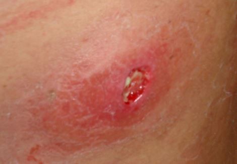 Sore Red Spot Under Armpit - Prijom News