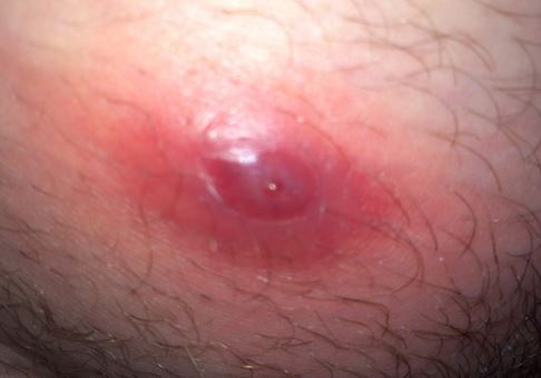 Purple Lump On Penis 97