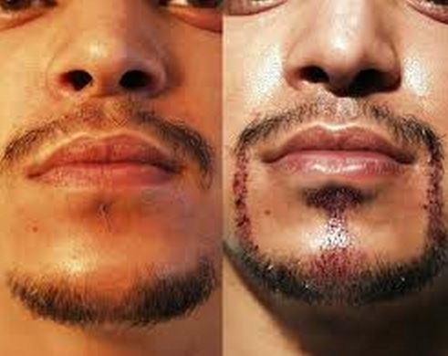 How To Stop Facial Hair Growth For Men 118