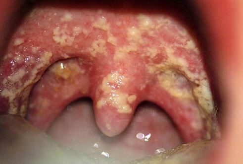 Green Spots On Throat 110