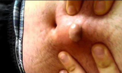 How do I pop an ingrown zit?