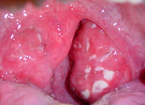 White Spots On Throat Not Strep 5