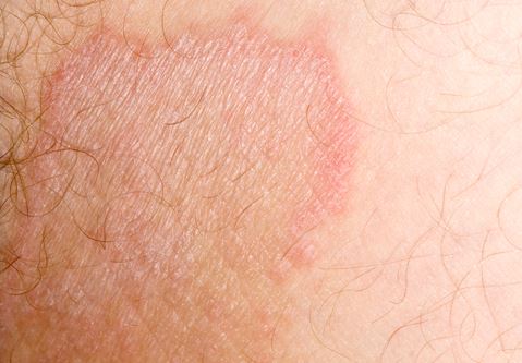 Groin rash - RightDiagnosis.com