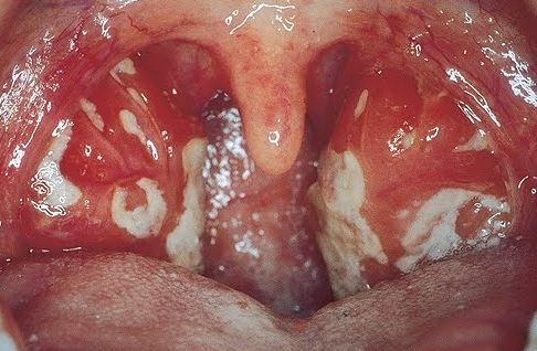 Throat Desease 61