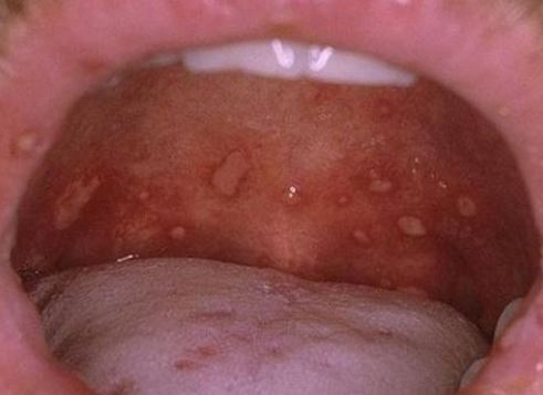 White Spots On The Back Of Throat 65