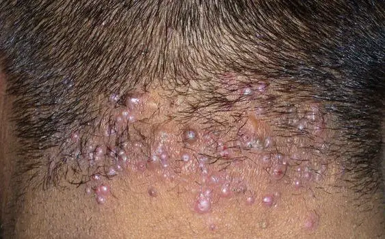Bump On Back Of Neck, Picture, Big, Hard, Small Painless ...