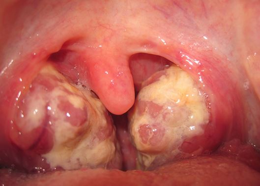Phlegm Lump Throat 5
