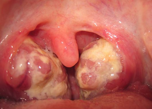 Mucous In Back Of Throat 98