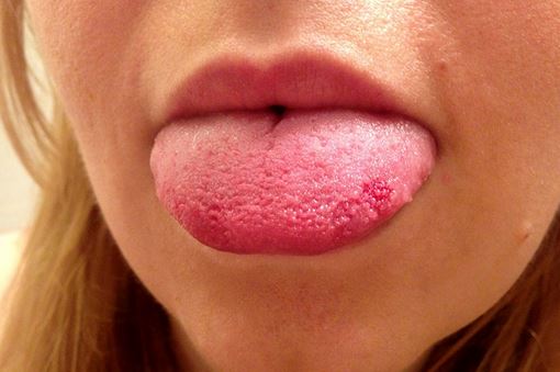 Inflamed circumvallate papillae - Answers on HealthTap