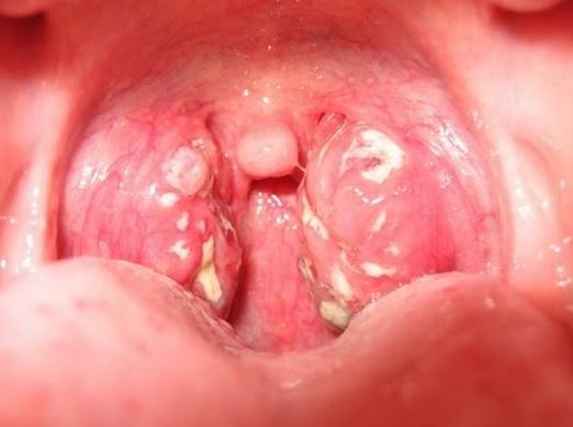 One Side Of Throat Swollen 67