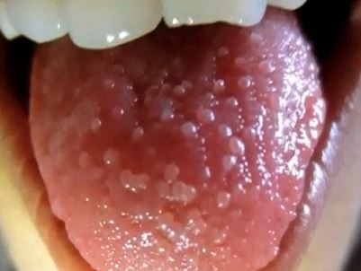 Why is the roof of my mouth swollen?