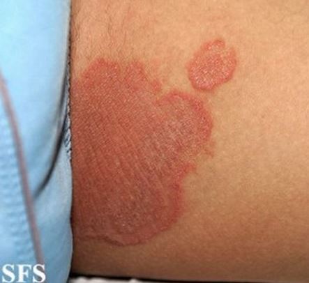 Penis problems | Odd looking patch on the penis