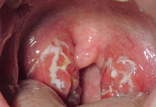 Green Spots On Throat 104