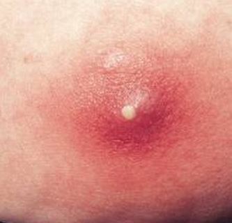 Sebaceous cyst - Wikipedia