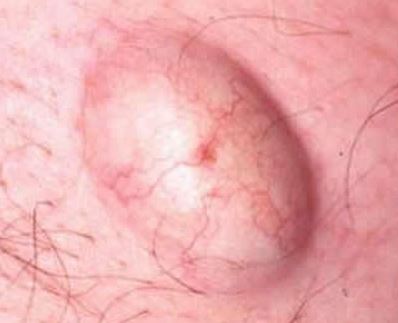 Sebaceous Cysts Causes, Symptoms, and Treatment