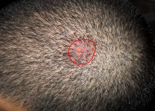 pink mole on scalp #11