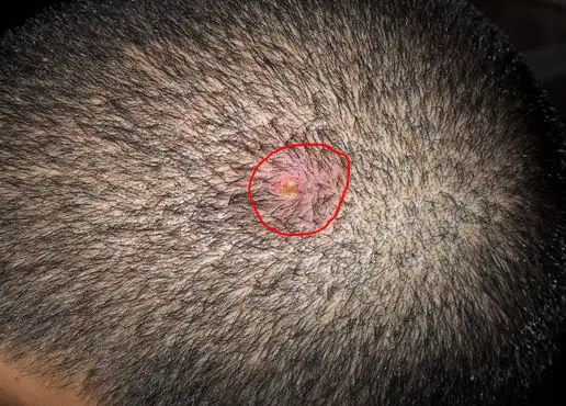 raised sores on scalp #11