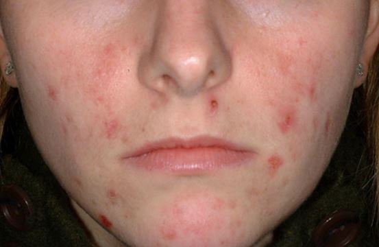 Cold Sores (Orofacial Herpes) in Adults: Condition ...