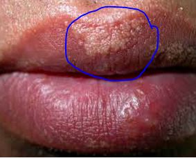Blisters on chin - Dermatology - MedHelp
