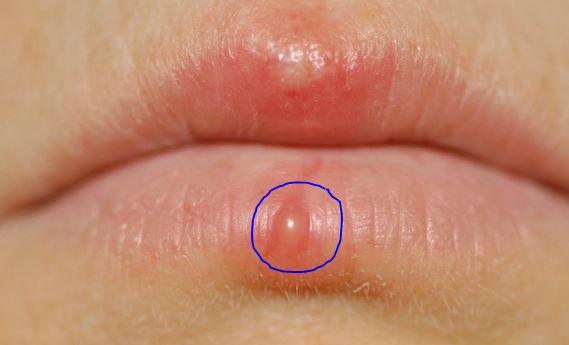 fluid filled bumps on lips