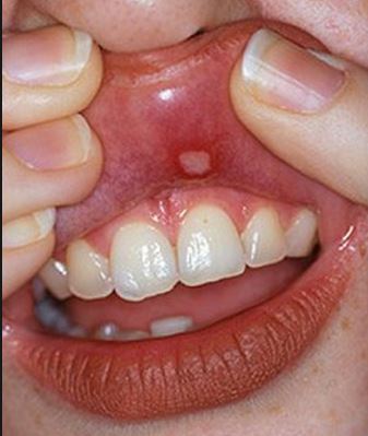 What causes bumps on your gum?
