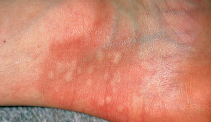 Painful Red Bumps On Hands And Feet - Doctor answers on ...