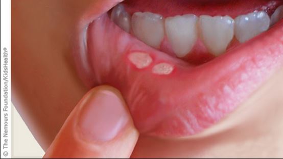 Tiny bumps inside lips --what are they?? - Dermatology ...