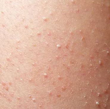 Blisters On Arms And Legs From Sun 43