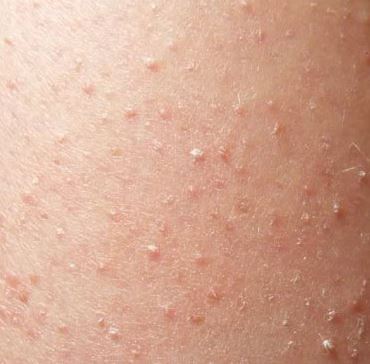 Small Bumps on a Toddler's Skin | LIVESTRONG.COM