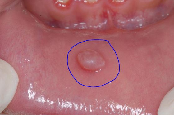 Small lump inside lower lip - Dermatology - MedHelp