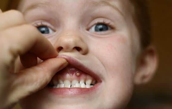 White Patch On Gums After Tooth Extraction