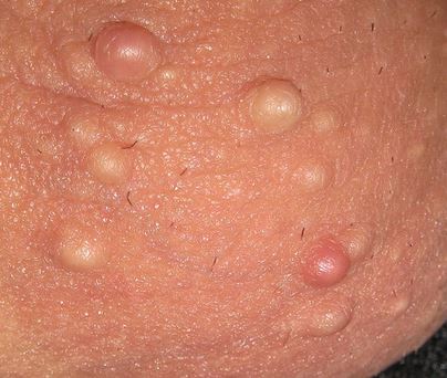 Pictures of STDs: Herpes, Genital Warts, Gonorrhea, STD ...