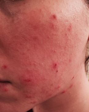  acne scabs - how to heal and get rid of scabs from pimples overnight