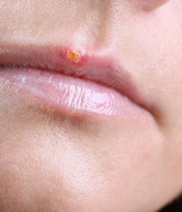 Scab on lips from bumps