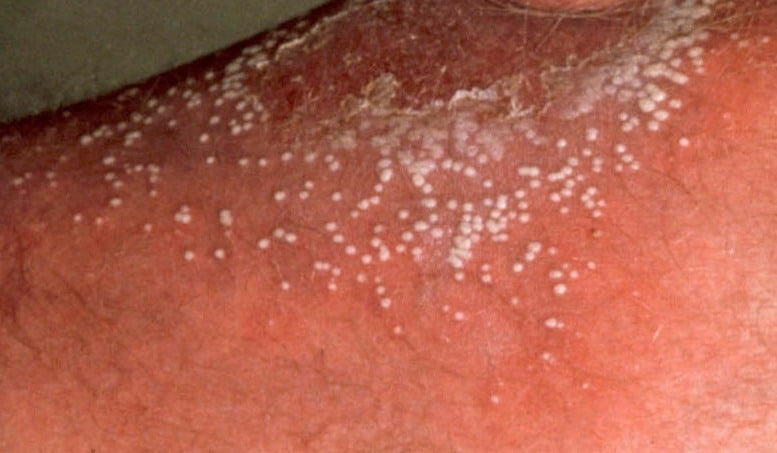 Small Itchy Clear Bumps - Skin Forum - eHealthForum