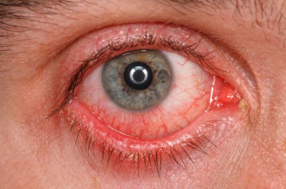 What are some treatments for a blister on the surface of the eye?