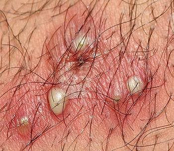 Herpes - spots on my ball sack. - Herpes - MedHelp