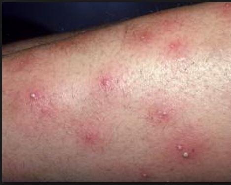 Steroid cream for itchy rash