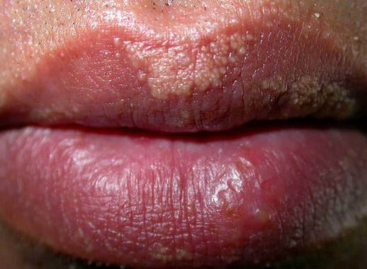Bumps on Lips - Healthline