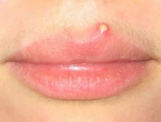 bumps on lower lip - MedHelp