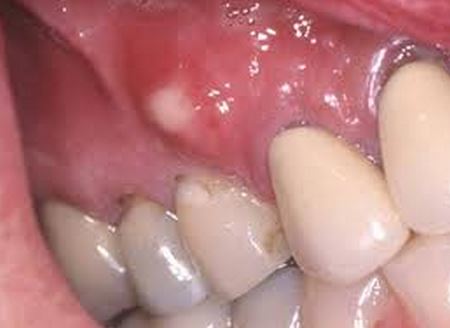 What causes bumps on your gum?